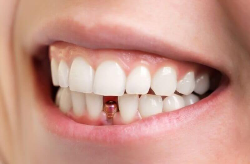 A Comprehensive Guide and the Cost of Dental Implants in Turkey